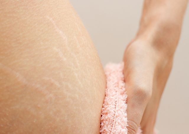 Cellulite als Toxin-Rückstau-Zeichen