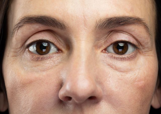 Augenringe als Zeichen von Toxinrückstau