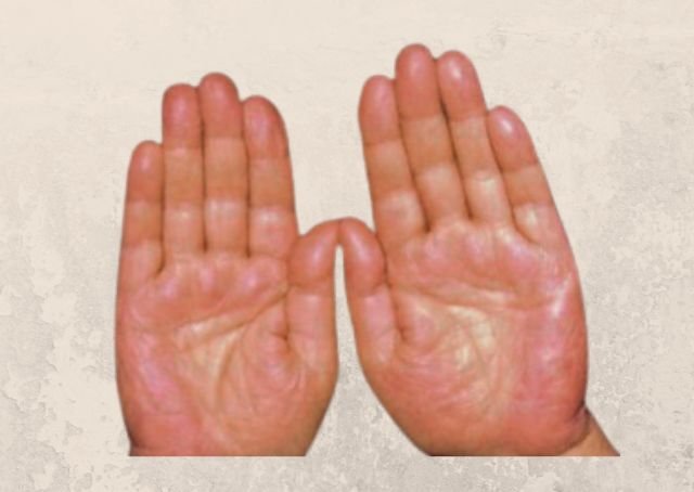Palmar-Erythem bei Leberstörung