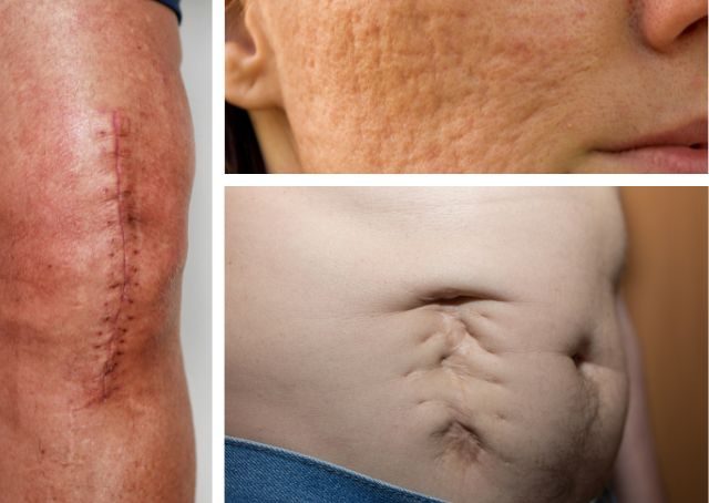 Schlechte Wundheilung - ein Proteinmangelsymptom?
